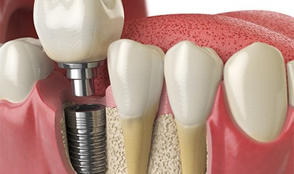 A 3D illustration of a dental implant fusing with bone