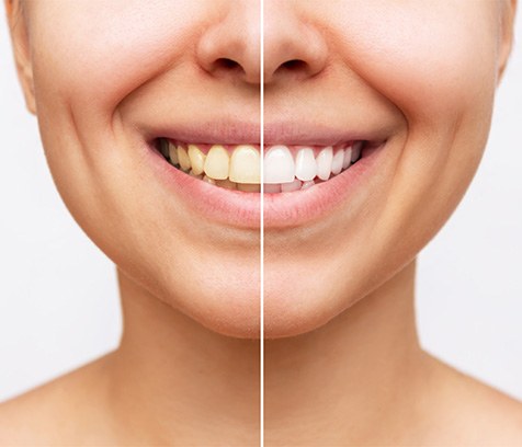 A before/after photo showing off teeth whitening results