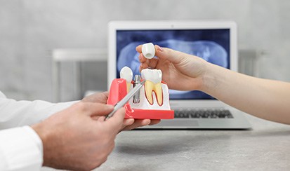 a model of dental implants