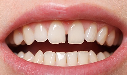a close-up of a patient with crowded teeth