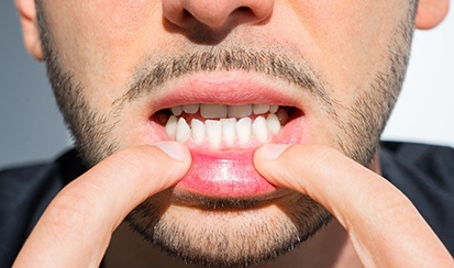 a woman with a visible overbite