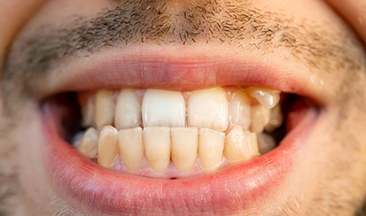 a patient with an underbite