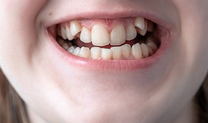 a patient with a crossbite