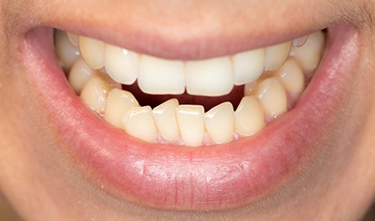 a close-up of a patient with an open bite