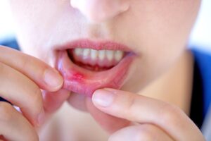 a patient with a canker sore