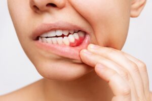 a patient with gum disease symptoms