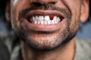 a young man with a missing tooth