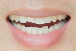 a close-up of chipped teeth
