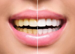 a patient before and after receiving teeth whitening treatment